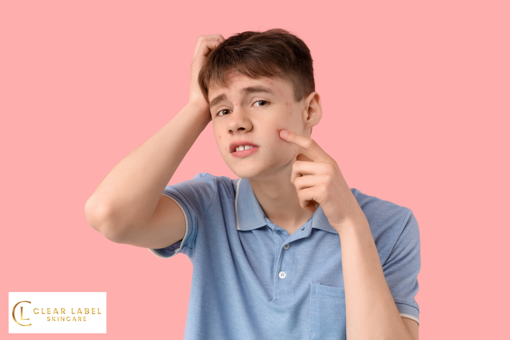 The Best Ways to Manage and Treat Teenage Acne